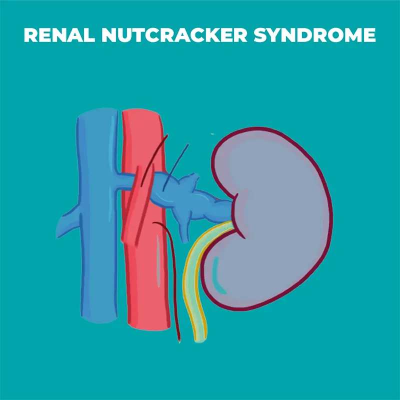Nutcracker Syndrome: Symptoms, Risk Factors, and Treatment